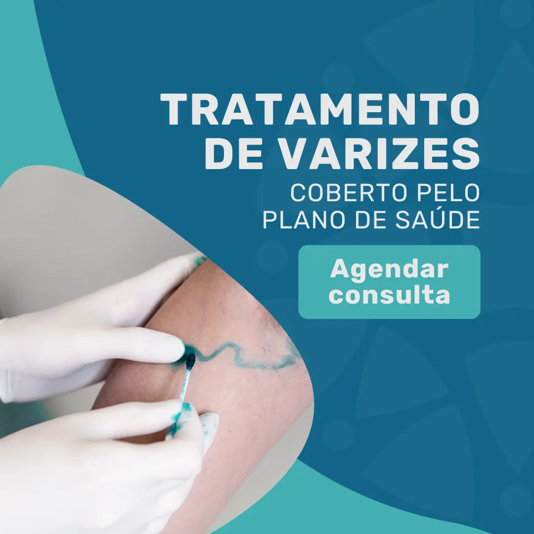 Faça o tratamento de varizes cirurgião vascular pelo bradesco