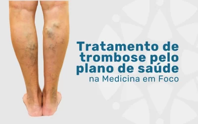 Tratamento de trombose pelo plano de saúde Bradesco